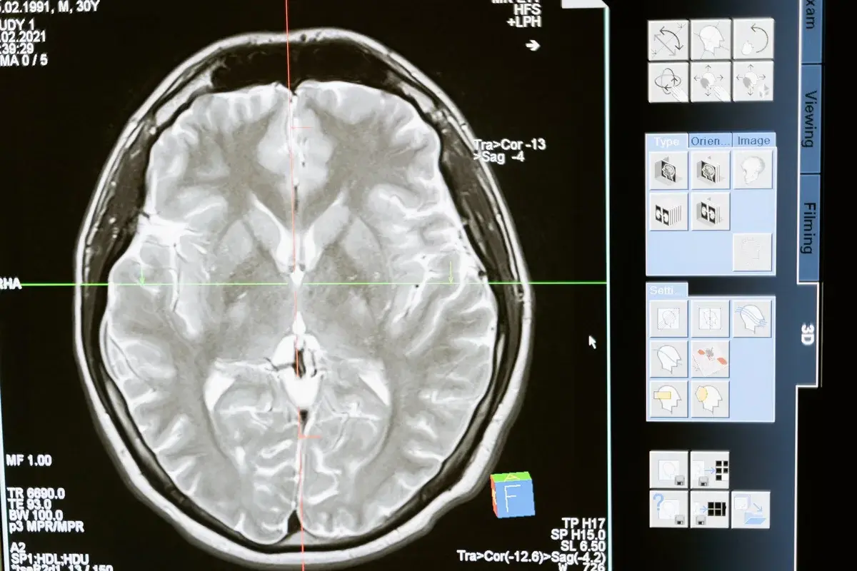 A brain MRI scan displayed on a computer screen.